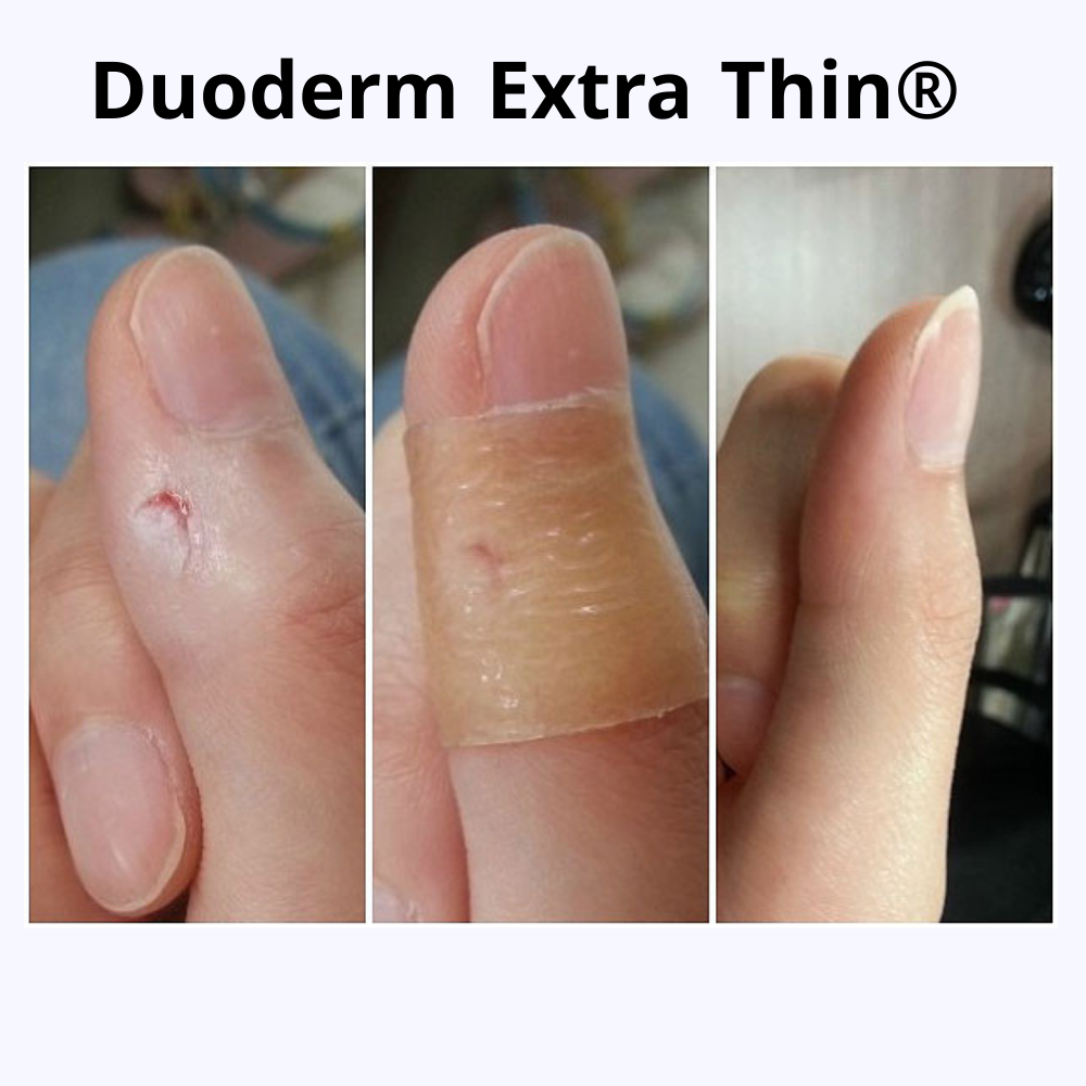 duoderm extra thin dressings duoderm extra thin dressings